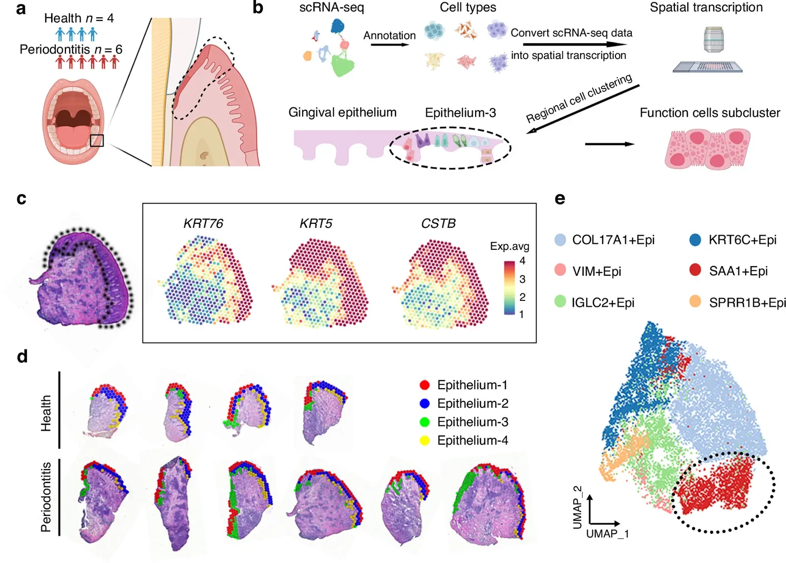 Spatial transcriptomics (ST) and scRNA-seq landscape in the gingival epithelium. a The gingival tissues were collected from 4 healthy controls and 6 periodontitis patients, and the gingival epithelium region. ST was performed on gingival tissues from 4 healthy controls and 6 periodontitis patients. scRNA-seq was performed on 2 healthy controls and 6 periodontitis patients. Because healthy gingival biopsies were limited in size and tissue allocation prioritized ST to preserve spatial information, paired ST and scRNA-seq data were available for only a subpopulation of healthy controls. b Schematic drawing of the combined scRNA-seq and ST. c The Epithelium in the slice of ST was recognized by marker genes ( KRT76 , KRT5 , CSTB ). d A dot plot showing the 4 major subclusters in different colors in the health group ( n = 4) and periodontitis group ( n = 6). e Uniform manifold approximation and projection (UMAP) of epithelial cell subclusters. The black circle indicates SAA1 +Epi